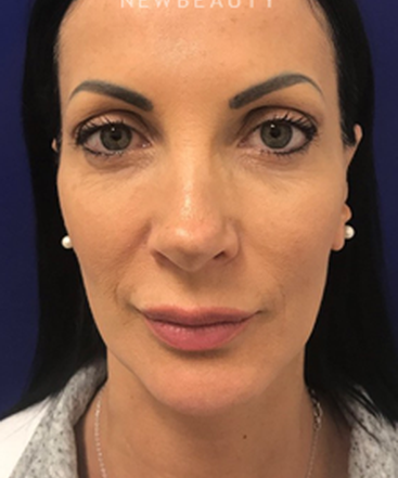 dr-dilip-madnani-minilift-injectables-b