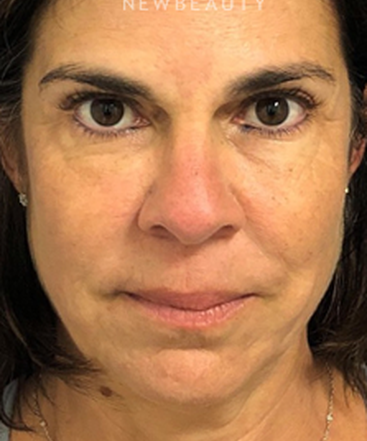 dr-dilip-madnani-facelift-necklift-b