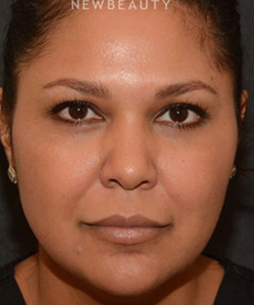 dr-janet-allenby-liquid-facelift-b
