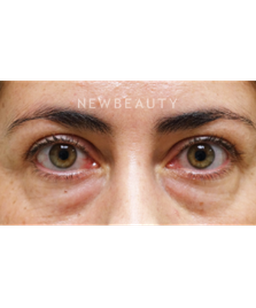 dr-raymond-douglas-eye-enhancement-b