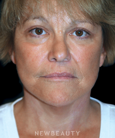 dr-brent-smith-eyelift-facelift-b