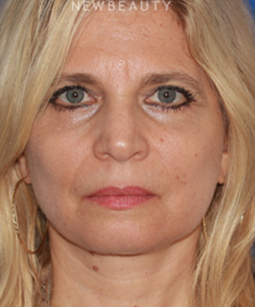 dr-konstantin-vasyukevich-upper-and-lower-blepharoplasties-b