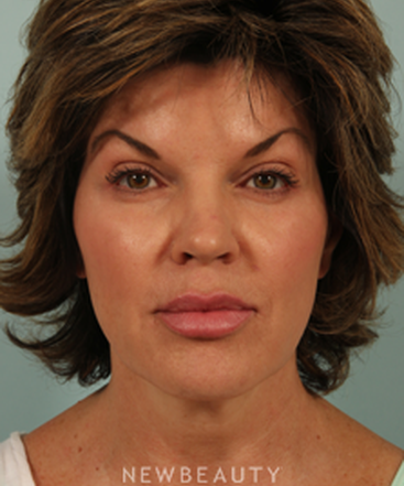dr-kenneth-beer-injectables-fillers-restylane-b
