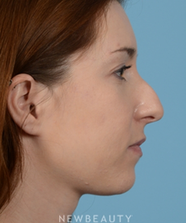 dr-jeffrey-wise-rhinoplasty-b