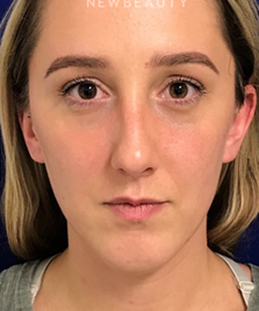dr-dilip-madnani-lower-blepharoplasty-b