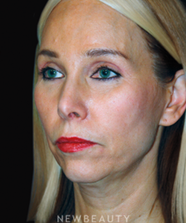 dr-brent-smith-facelift-rhinoplasty-lasers-chin-augmentation-b