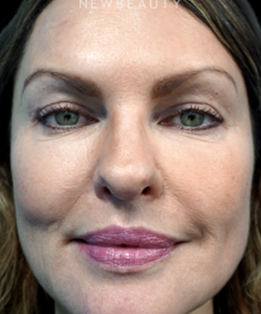 dr-niki-christopoulos-upper-blepharoplasty-b
