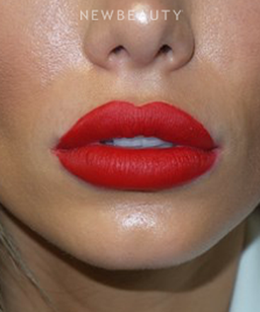 dr-sanjay-grover-restylane-silk-b