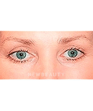 dr-sanjay-grover-blepharoplasty-b