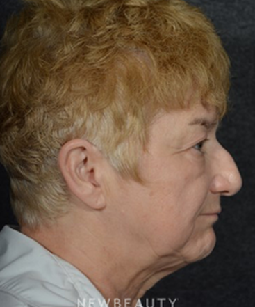 dr-ryan-chastant-rhinoplasty-b