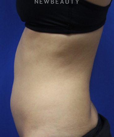 dr-jennifer-levine-sculpsure-b