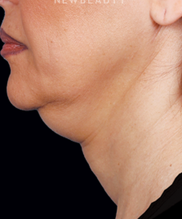 dr-ava-shamban-injectables-fillers-b