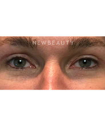 dr-baljeet-k-purewal-upper-blepharoplasty-b