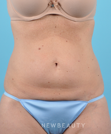 dr-bradley-bengtson-coolsculpting-b