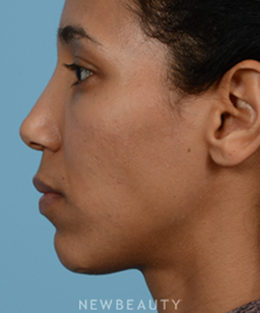 dr-jeffrey-b-wise-nasal-tip-refinement-b