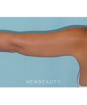 dr-sean-simon-smartlipo-b