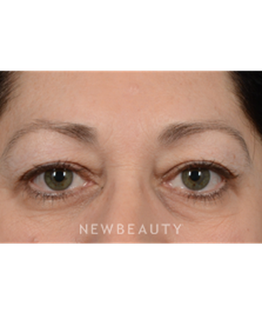 dr-jeffrey-wise-upper-blepharoplasty-b