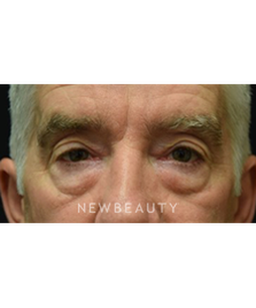 dr-jeffrey-b-wise-eyelift-b