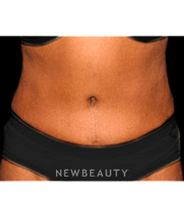 dr-sanjay-grover-tummy-tuck-b