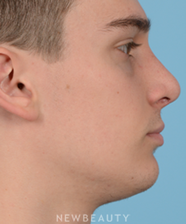 dr-jeffrey-wise-rhinoplasty-b