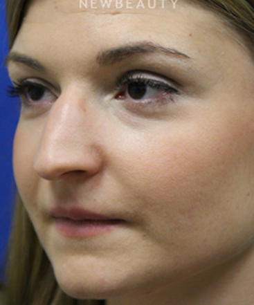 dr-jennifer-levine-rhinoplasty-b