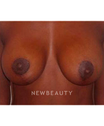 dr-michael-horn-breast-lift-b