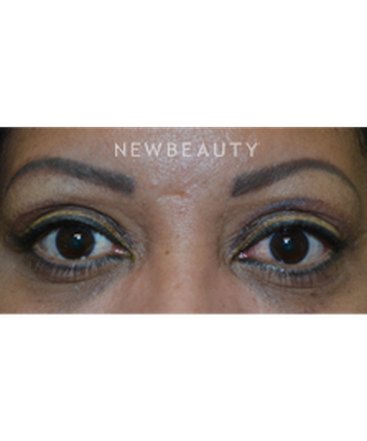 dr-baljeet-k-purewal-upper-blepharoplasty-b