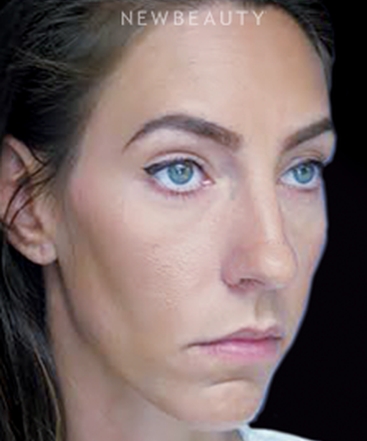 dr-joseph-russo-under-eye-rejuvenation-b