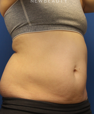 dr-jennifer-levine-sculpsure-b