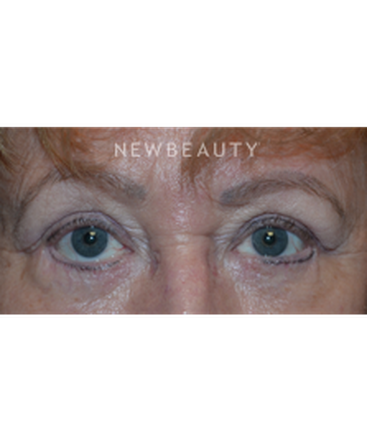 dr-baljeet-purewal-blepharoplasties-b