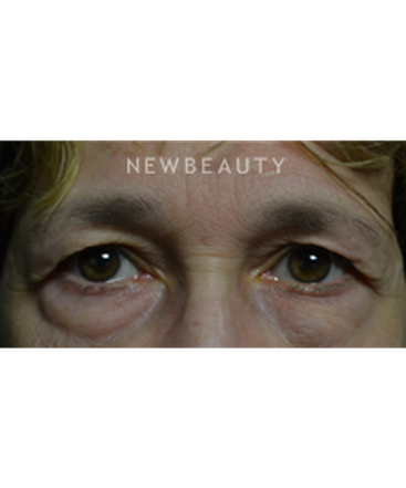 dr-baljeet-purewal-blepharoplasties-b