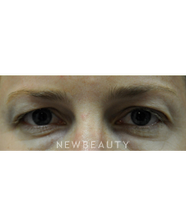 dr-baljeet-purewal-upper-blepharoplasty-b