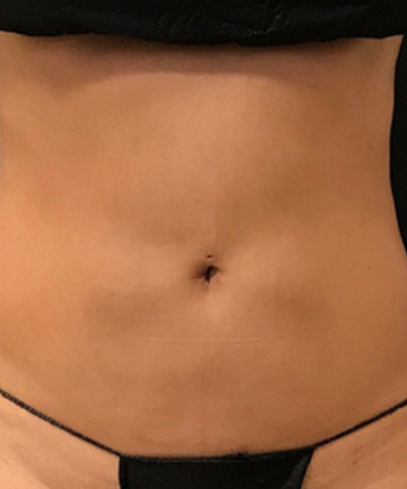 dr-janet-allenby-coolsculpting-b