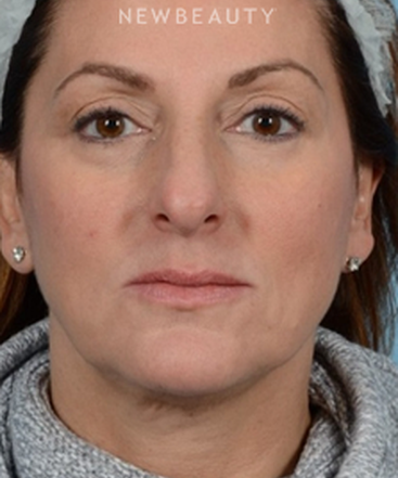 dr-jeffrey-wise-rhinoplasty-b