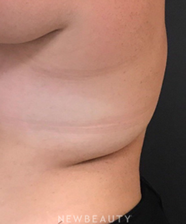 dr-janet-allenby-coolsculpting-b