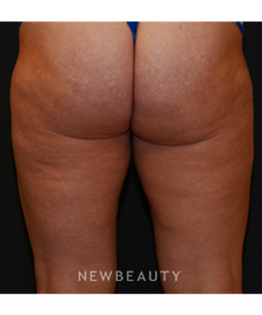 dr-janet-allenby-body-sculpting-b