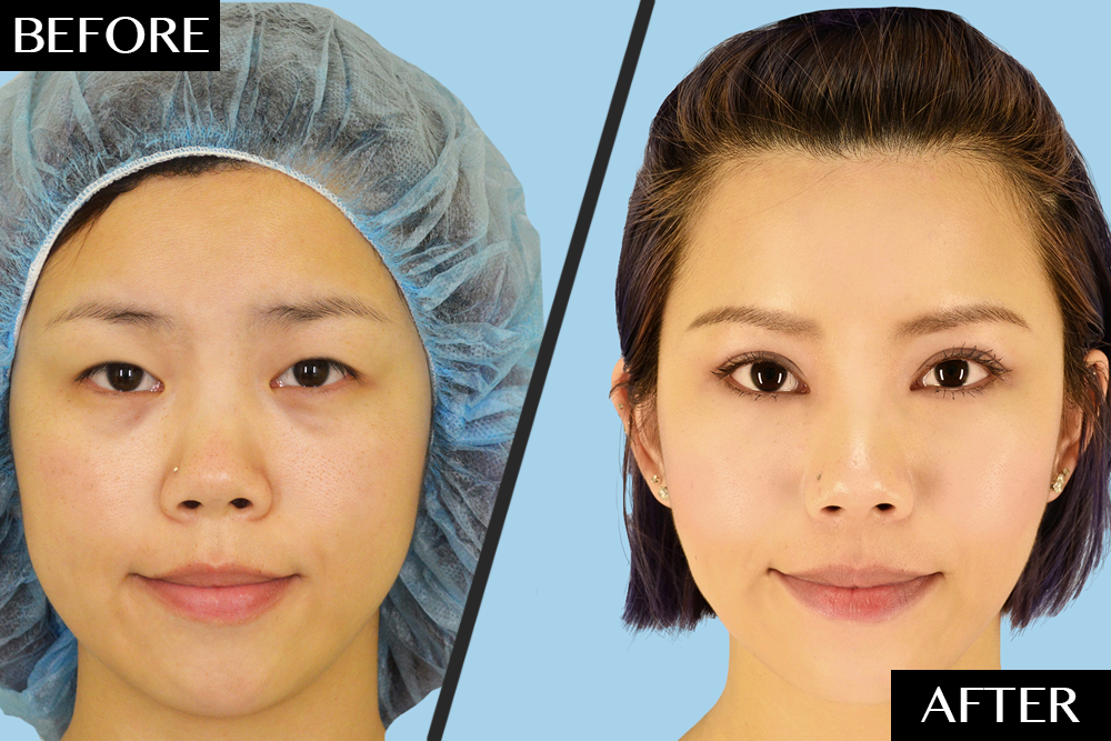 Asian Double Eyelid Surgery Cases Newbeauty