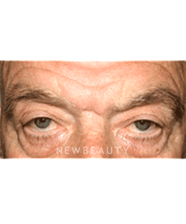 dr-sanjay-grover-blepharoplasty-b