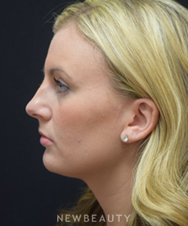 dr-jeffrey-b-wise-rhinoplasty-b