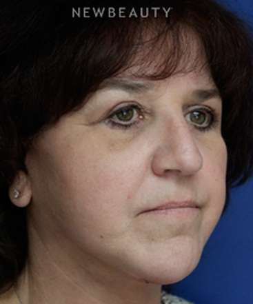 dr-joseph-russo-restoring-a-natural-look-eye-ebg-b