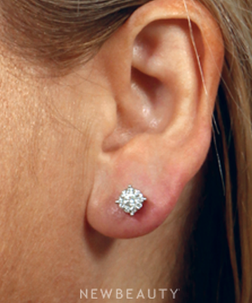 dr-kenneth-beer-ear-repair-b