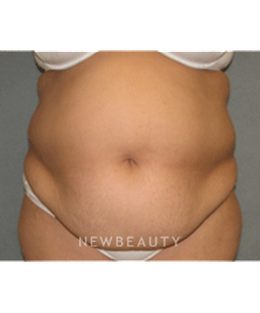 dr-sean-simon-tummy-tuck-lipo-b