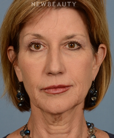 dr-bryan-w-gawley-facial-rejuvenation-b