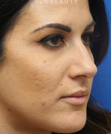 dr-jennifer-levine-rhinoplasty-b