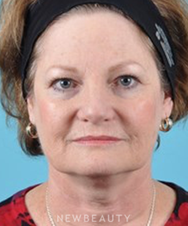 dr-brad-bengtson-facelift-b