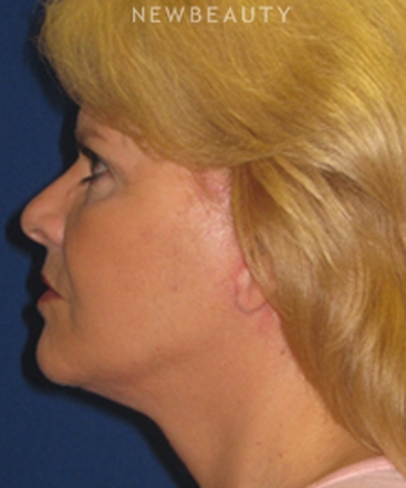 dr-dilip-d-madnani-facelift-necklift-b