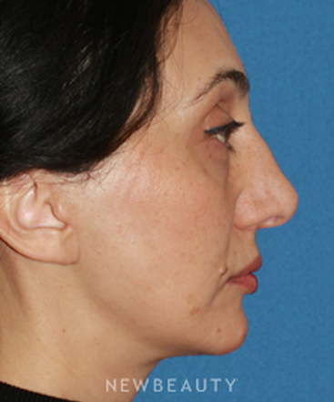 dr-konstantin-vasyukevich-traditional-facelift-b