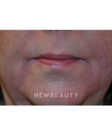 dr-baljeet-purewal-liquid-facelift-b