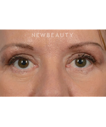 dr-jeffrey-wise-upper-and-lower-blepharoplasty-b