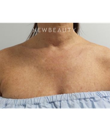 dr-marina-peredo-skinfluence-trinity-treatment-b